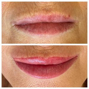 Cosmetic Lip Tattoo Before And After